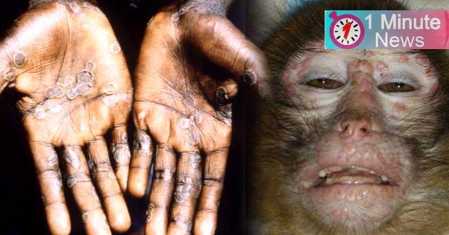 monkey pox speared may grow fast alart by 'who' for every country